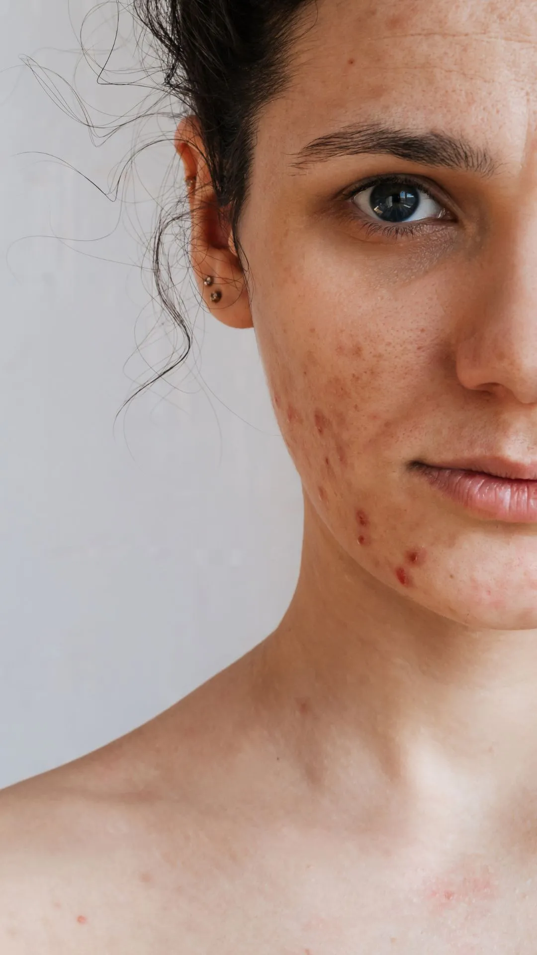 5 daily habits that cause acne