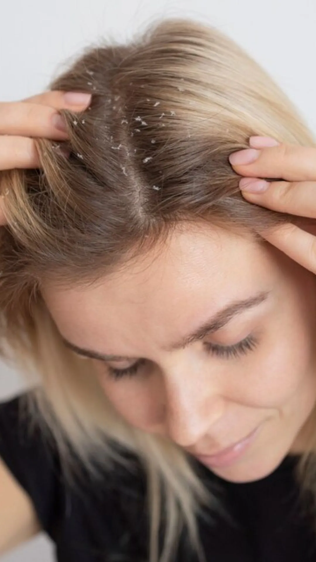 5 easy home remedies for dandruff