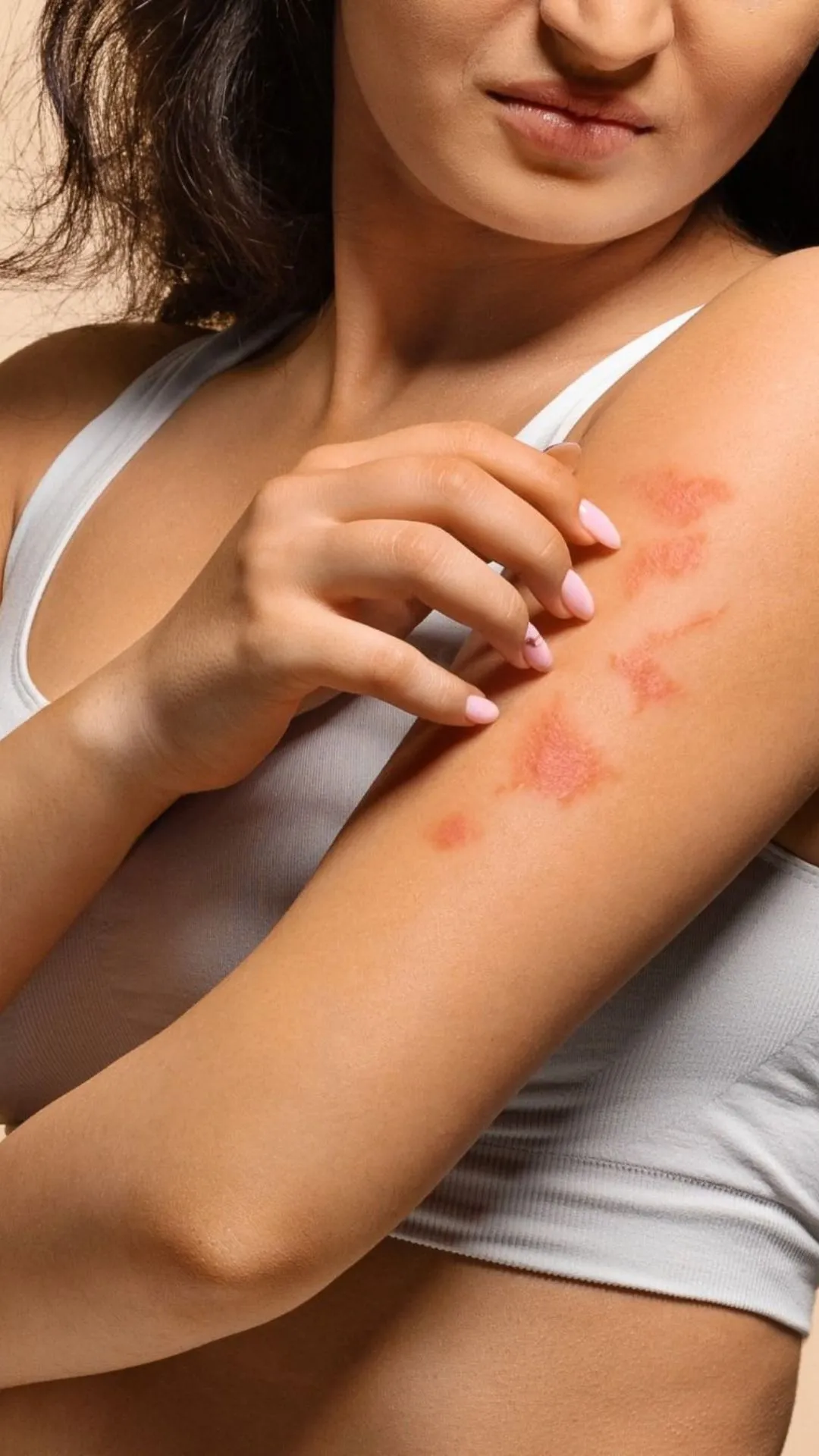 5 strange health conditions linked to insect bites