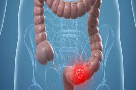 Scientists discover rare form of hereditary colon cancer – India TV