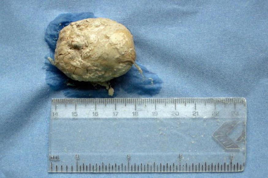 India's biggest bladder stone weighing 1.4 kg removed: Doctor