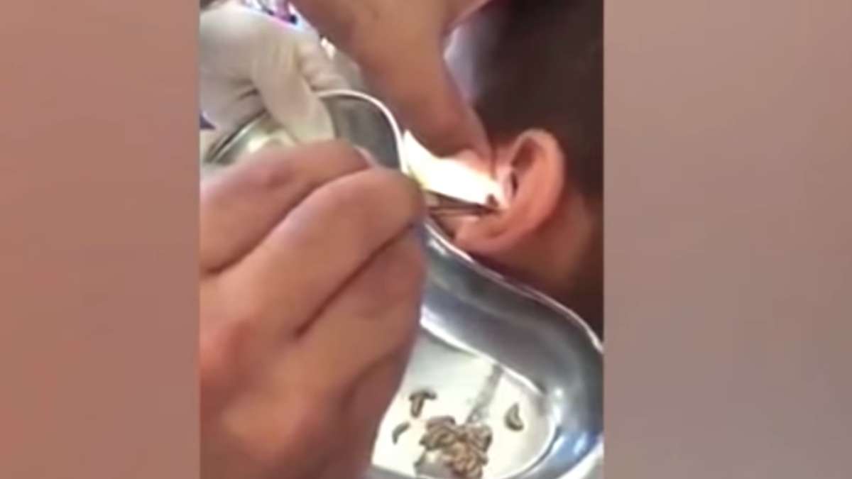 Kazakhstan Horror: Doctors pulled out living larvae of blow fly from a  boy's ear. Watch video – India TV