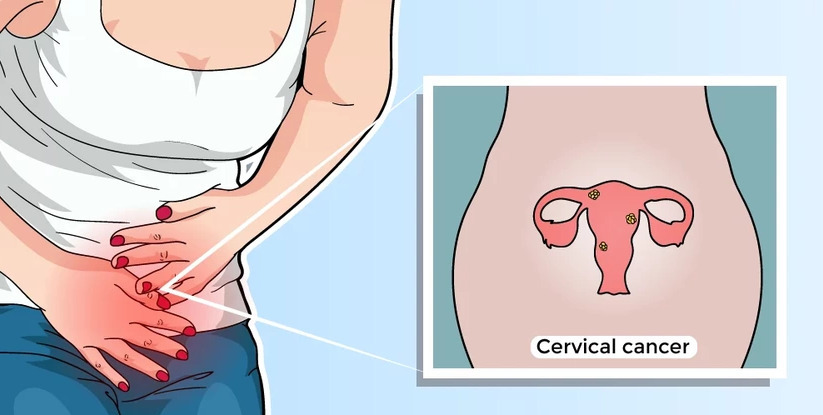Cervical Cancer Is Easily Preventable All You Need To Know About This Cancer Health News India Tv