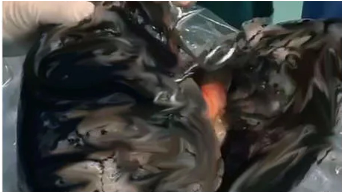 Quit smoking now! This chain smoker's lungs have turned completely black, watch viral video