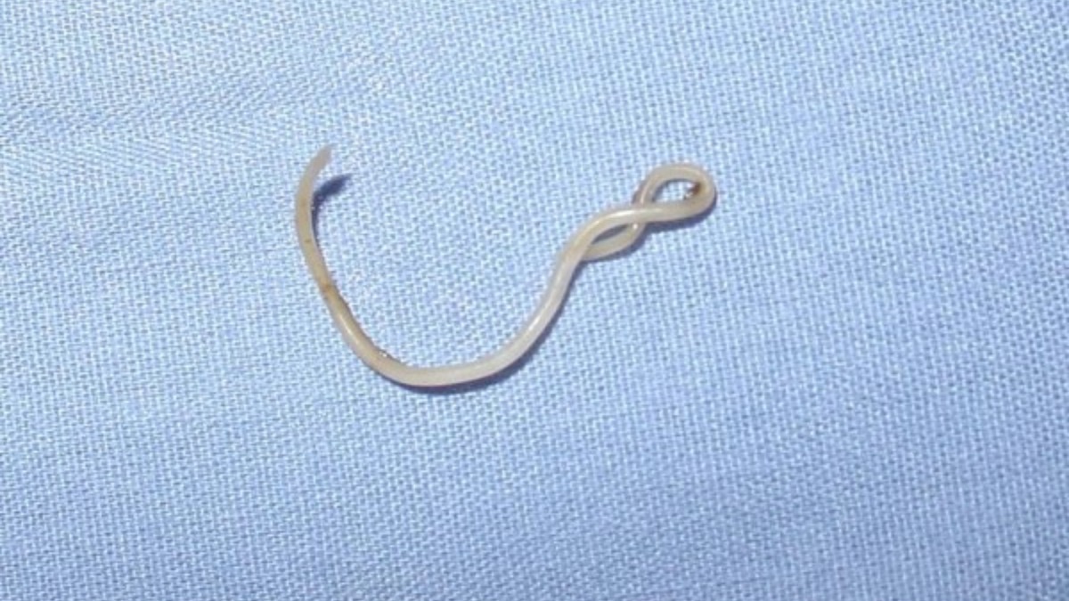 38-mm-long roundworm found in woman's tonsil in Japan – India TV