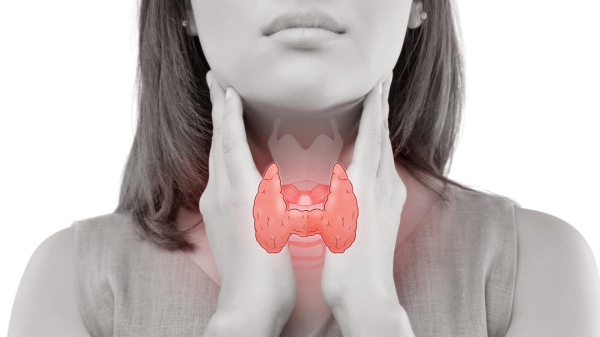 Thyroid gland cancer, illustration | Stock Image - Science Source Images