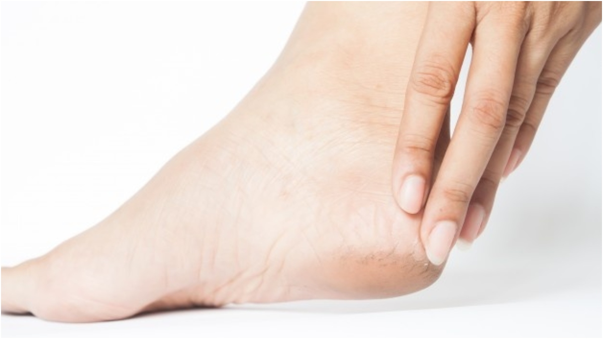 Have cracked heels during winters? These natural ways will help them heal