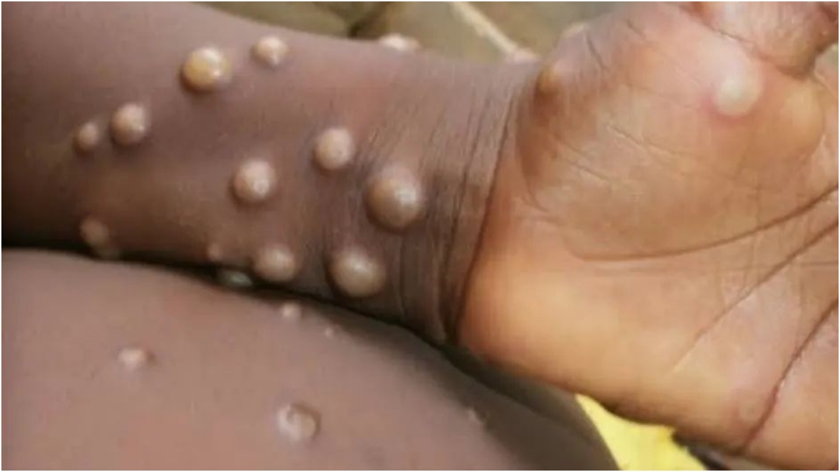 What is Monkeypox? Know how it spreads, symptoms and treatment