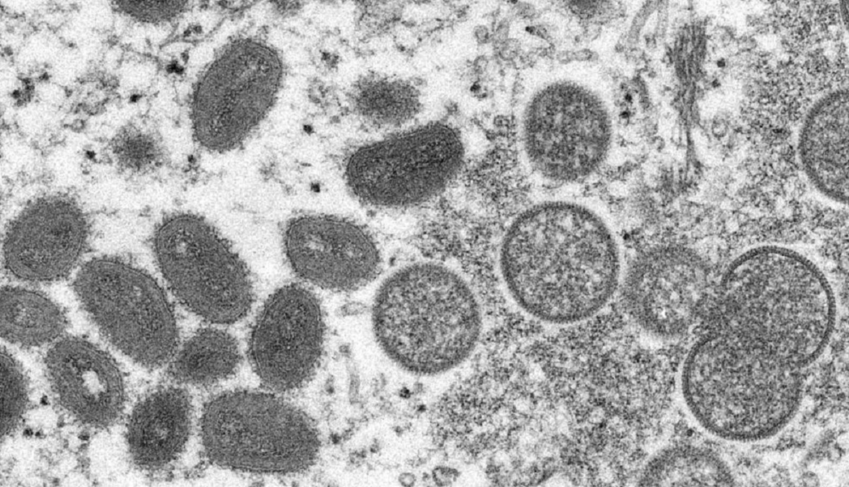Monkeypox virus: Third case confirmed in Kerala, man arrived from UAE earlier this month