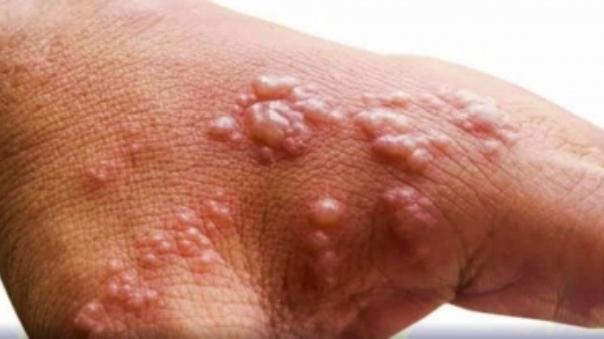 Can Monkeypox infections turn dangerous? Know what experts have to say