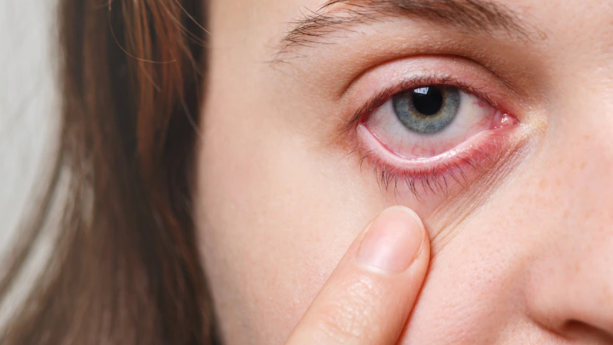 Suffering From Itchy Eyes Know Symptoms And Treatment Suffering News 