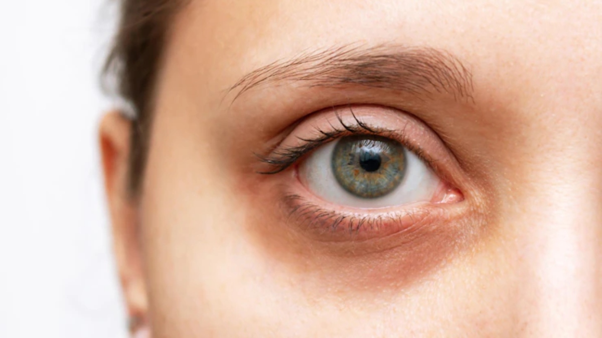 dark-circles-under-the-eyes-causes-treatment-and-effective-home-remedies-to-get-rid-of-it