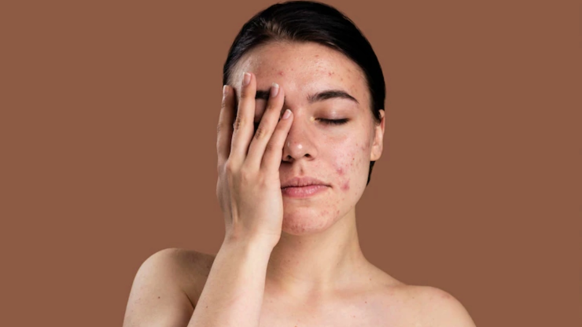 Want to get rid of acne scars? Try these 5 home remedies to lighten the marks