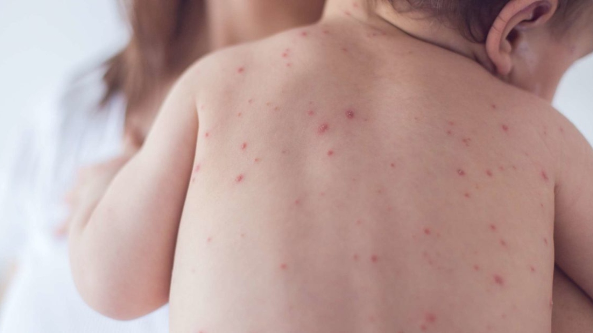 If you've already had measles once, can you get it again? Know the ...