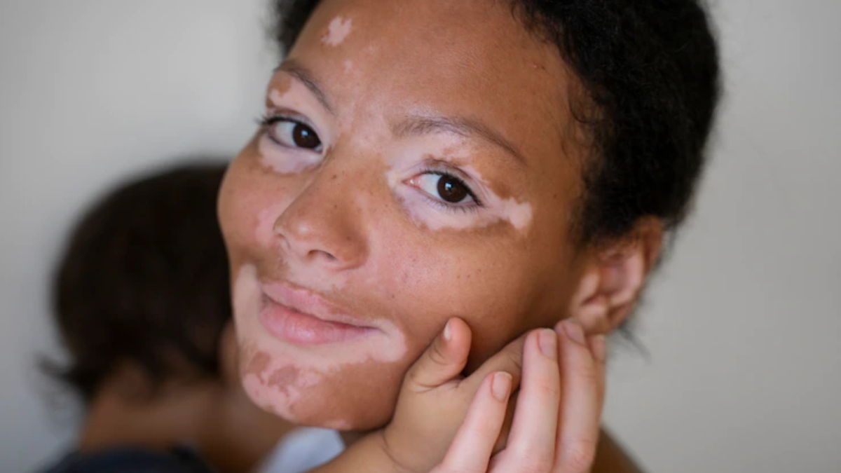 How To Detect Vitiligo Know Signs And Symptoms Of Skin Condition That 