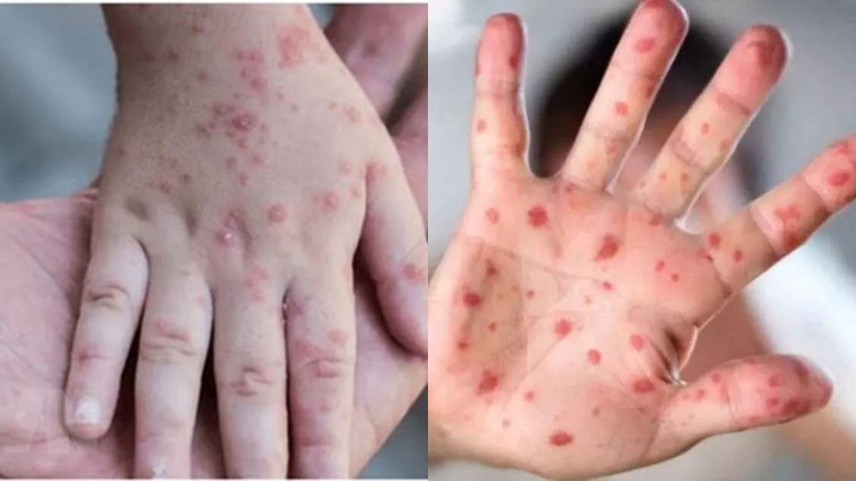 Monkeypox To Tomato Flu 10 Deadly Diseases That Stirred The World In   Virus 1671442714 