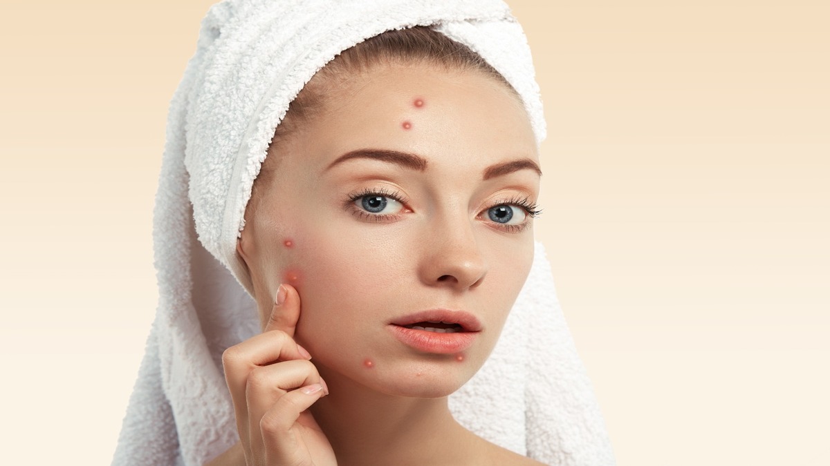 Try these five simple and effective natural acne treatments at home
