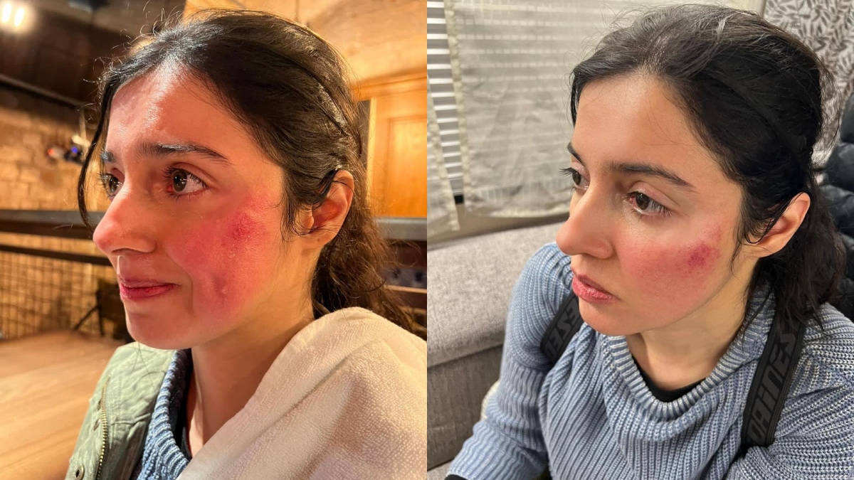 Divya Khosla Kumar gets injured while shooting for her upcoming project | Deets inside