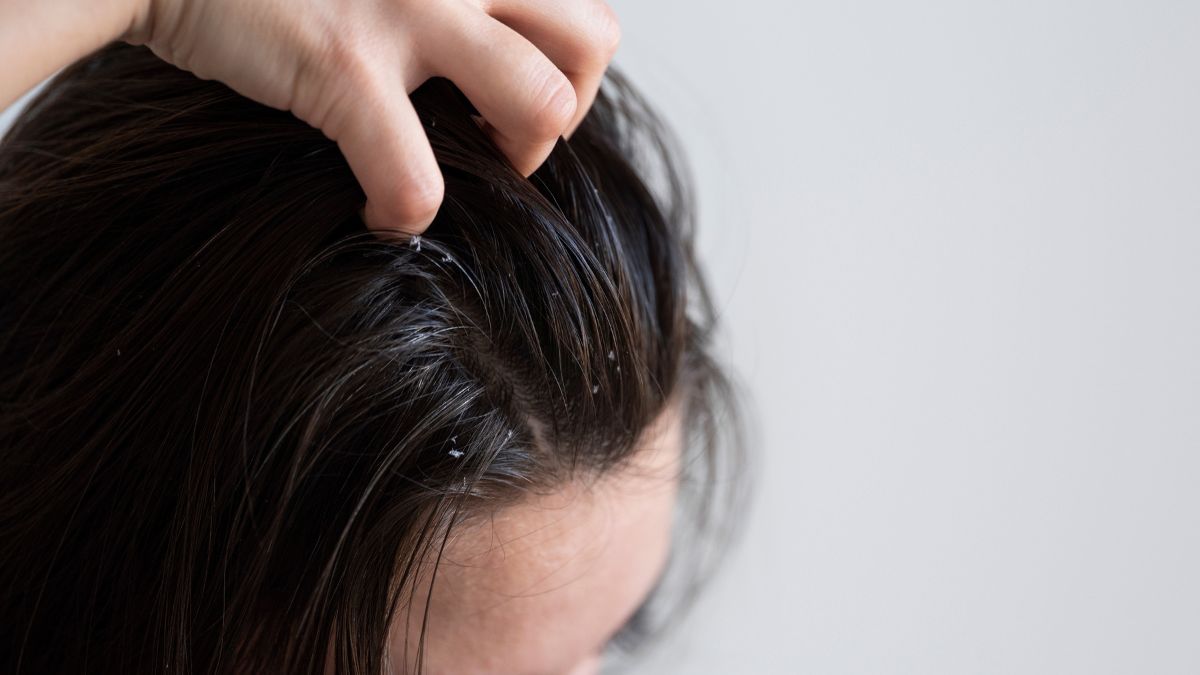 Dandruff: Here are easy home remedies to eliminate this scalp condition