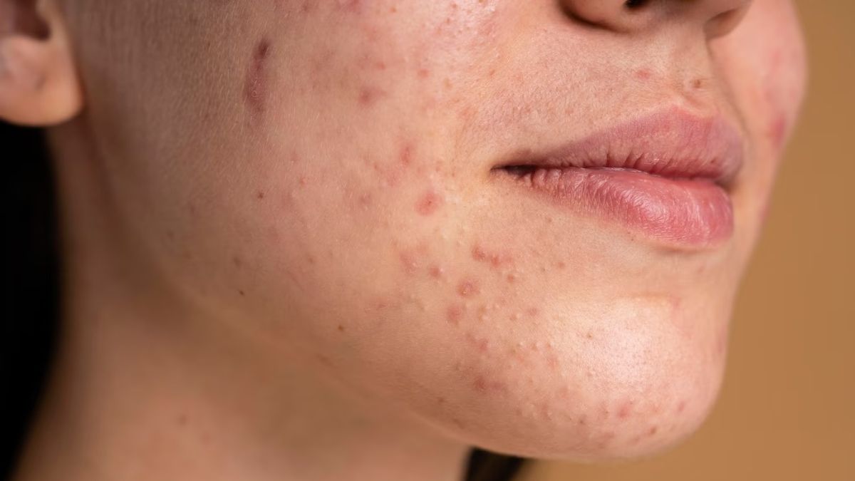 What are dark spots on skin and How Can You Treat Them?