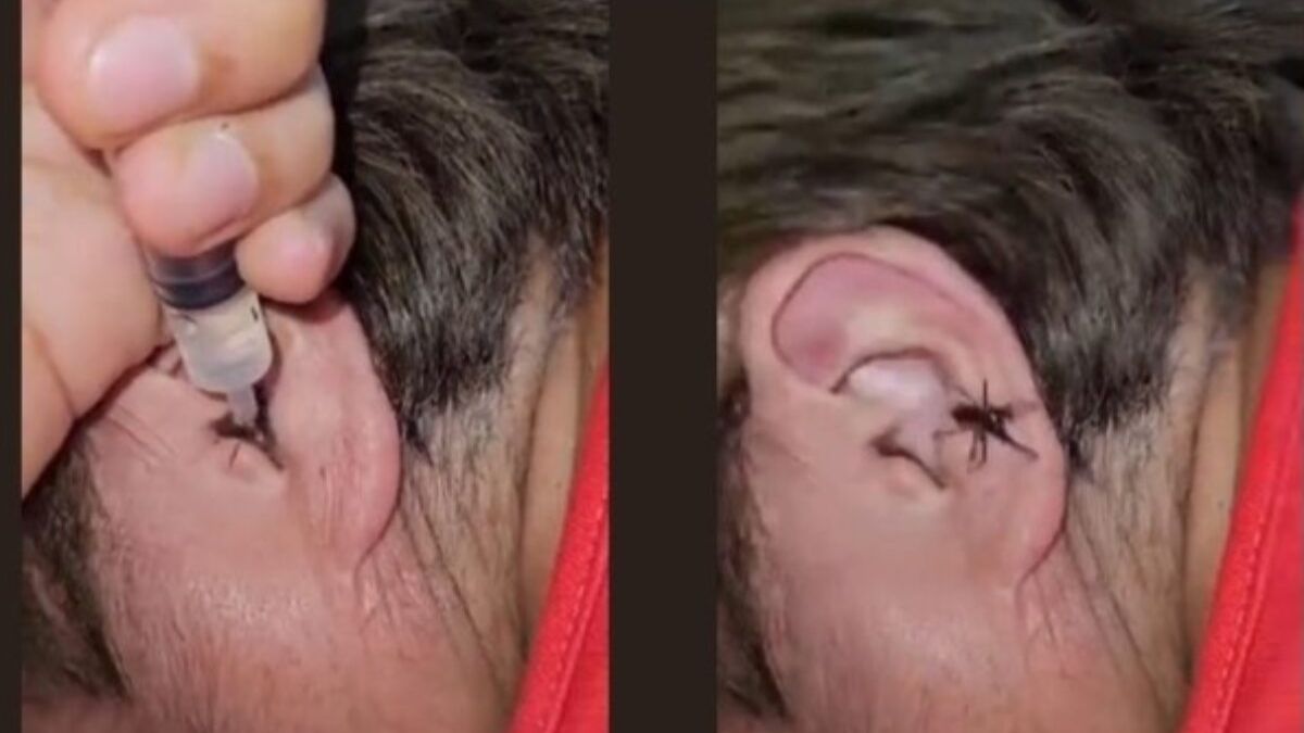 Spider crawls out of man's ear, viral video creeps out netizens. Watch