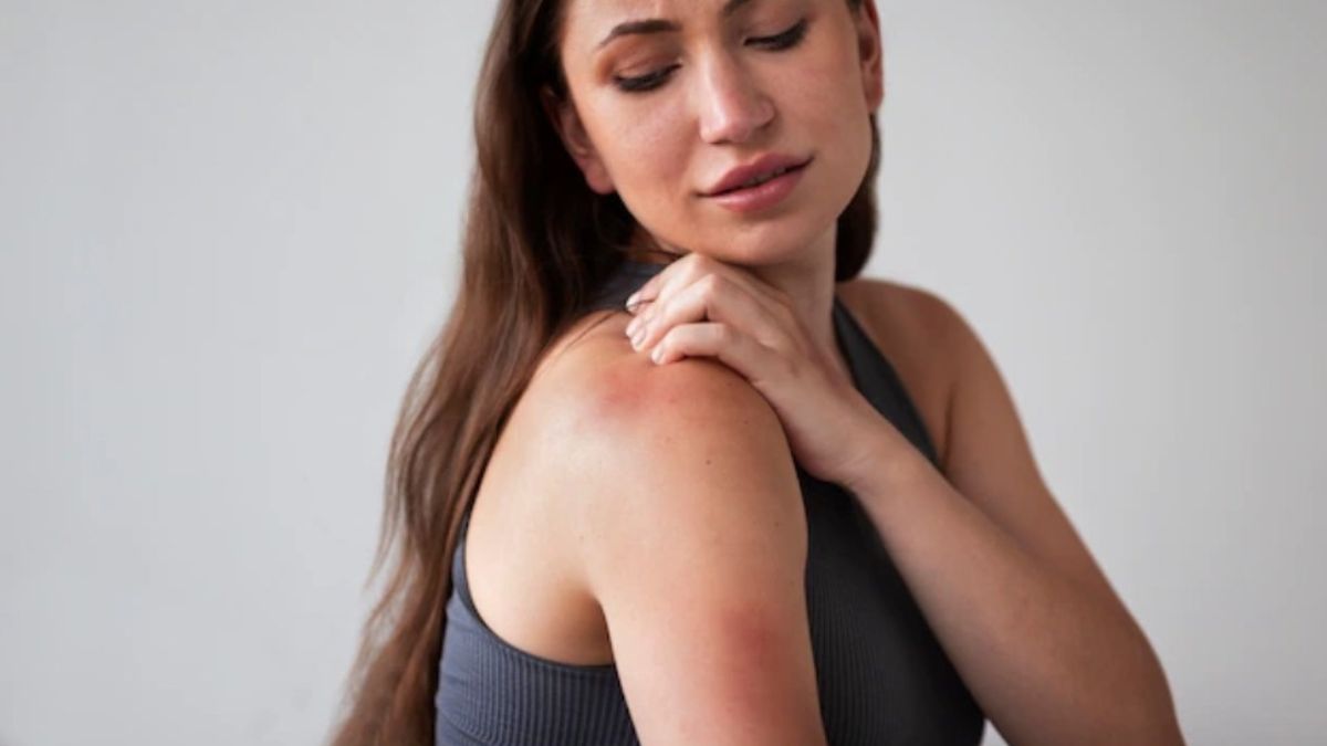 High temperatures can result in heat rashes; five ayurvedic remedies to treat them