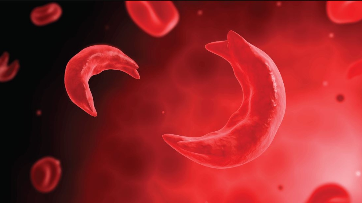 What is National Mission Sickle Cell Anaemia? Modi government plans to eradicate the disease