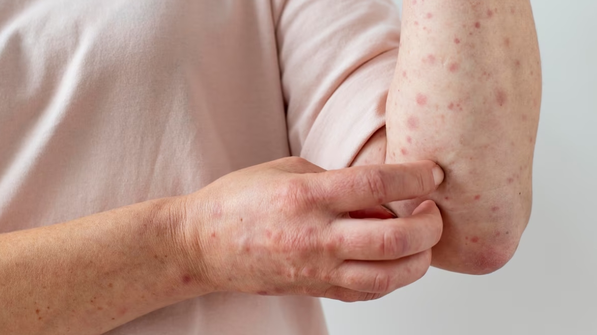 Clade 9: New variant of chickenpox virus detected in India, know symptoms and prevention tips – India TV