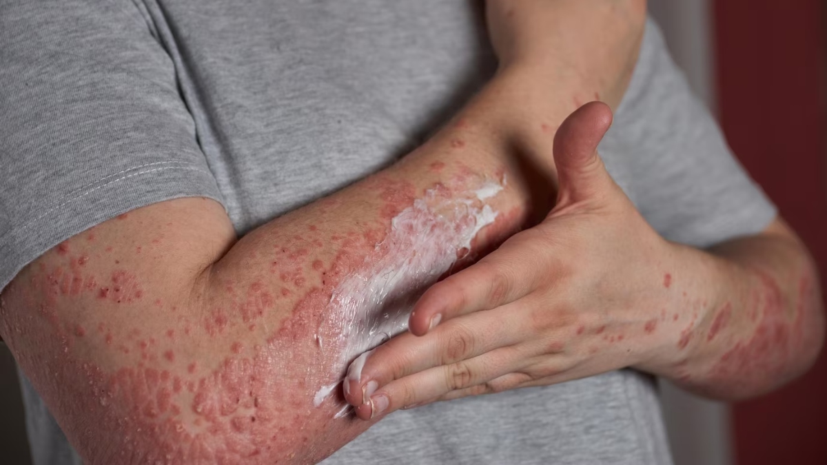 Psoriasis can increase cardiovascular disease risk, finds study