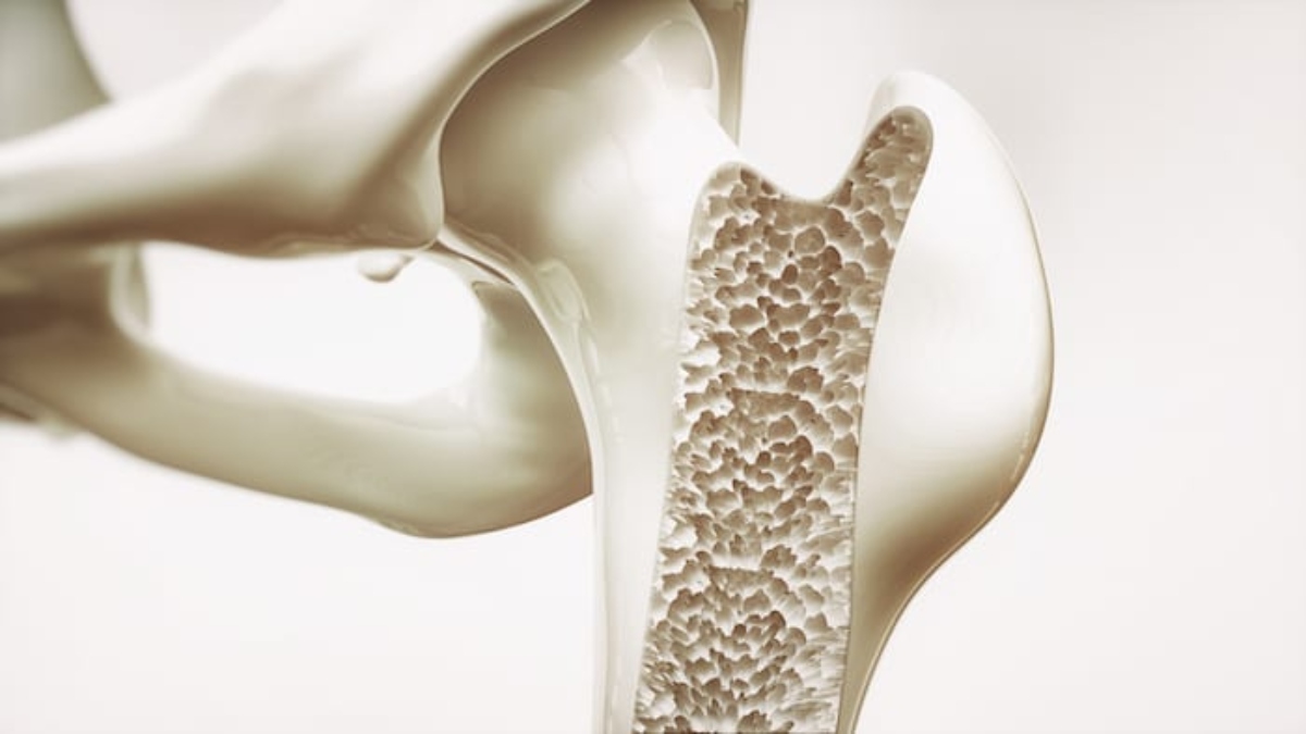 Osteoporosis: What is it — Symptoms, Risk and Remedies