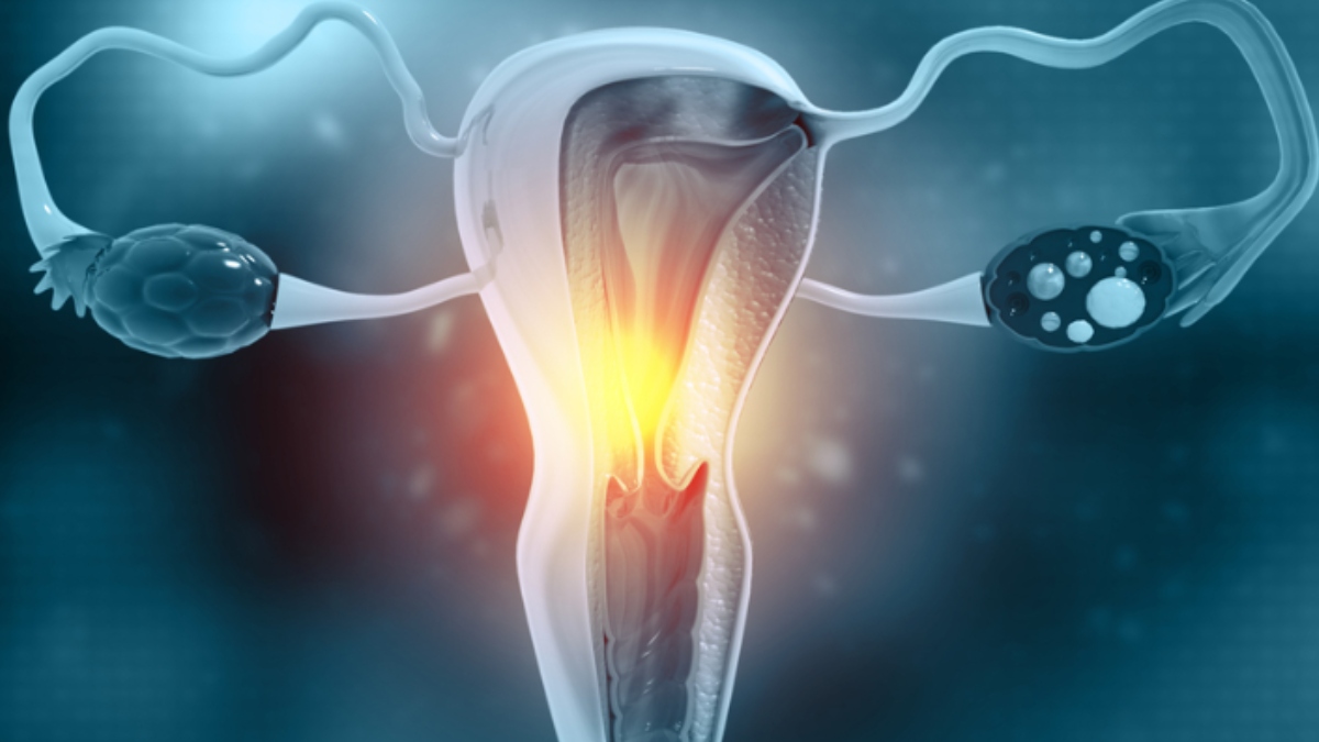 What is Anti-Mullerian Hormone? Know the difference between high and low AHM levels in ovaries