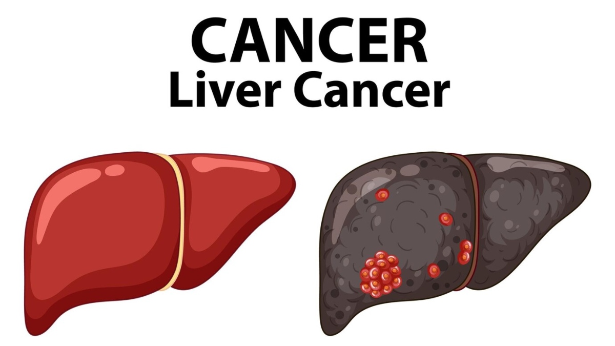 Target therapy may cure Liver Cancer, claims research – India TV