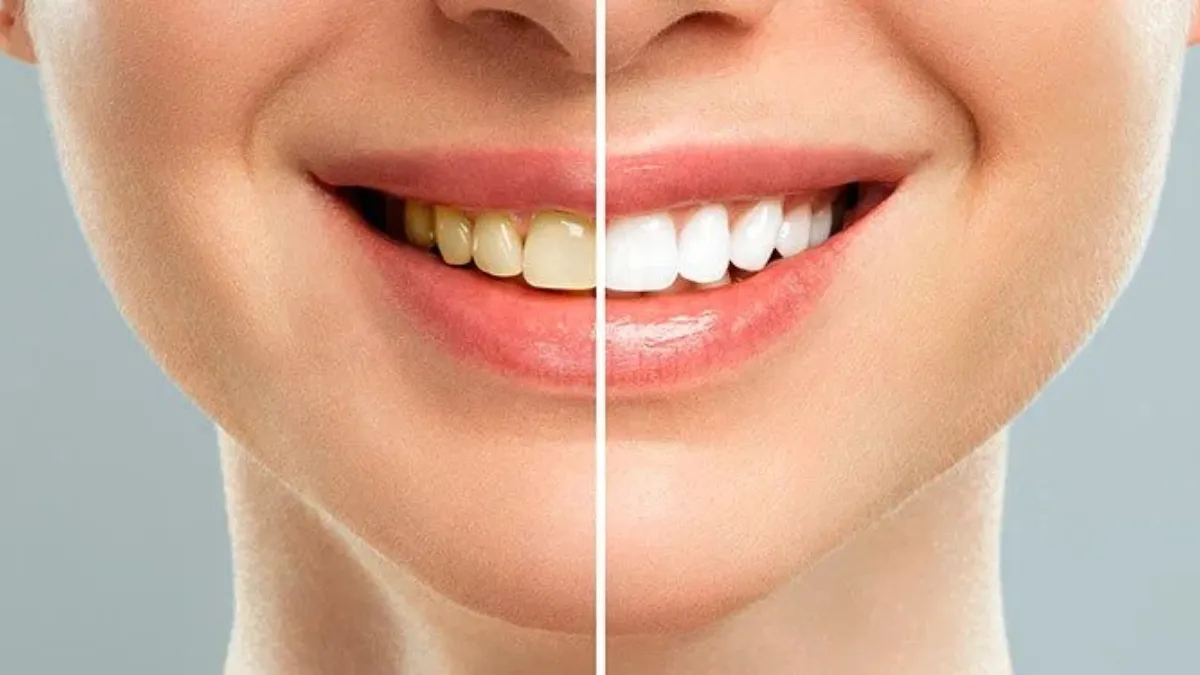 5 ways to get rid of yellow teeth