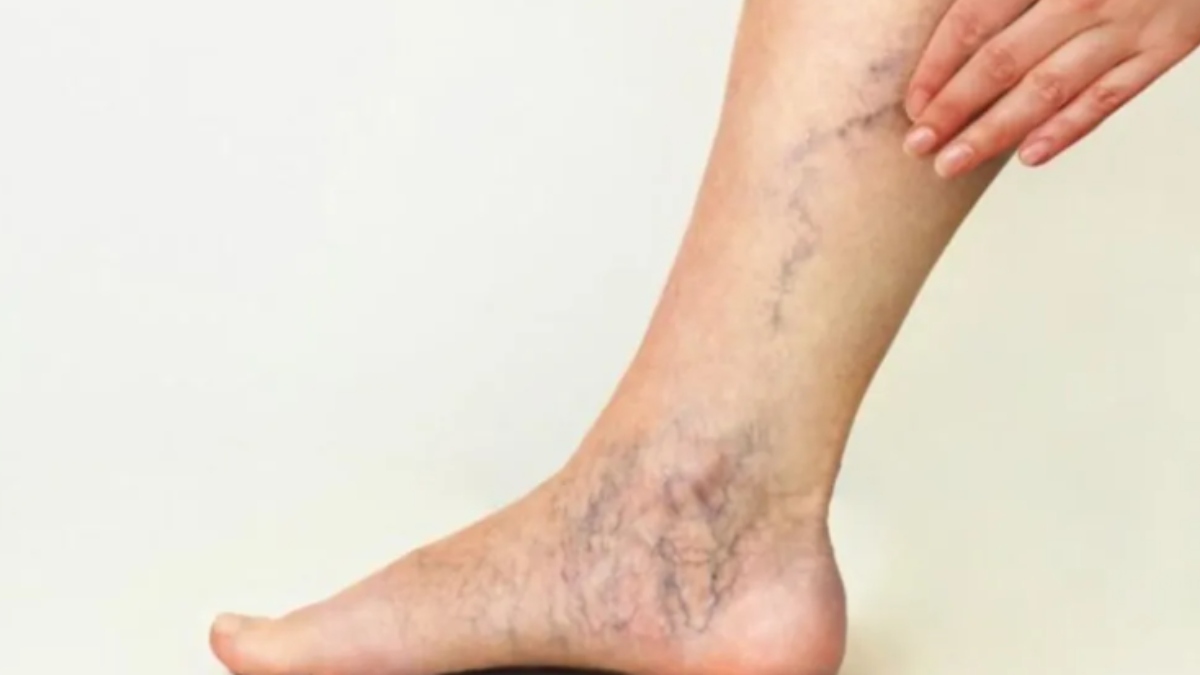 Varicose Veins problem Treat this condition with A
