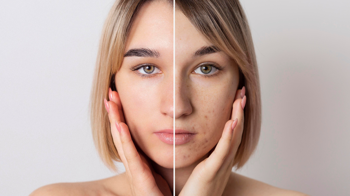 International Skin Pigmentation Day 2024: Know date, history, significance and more