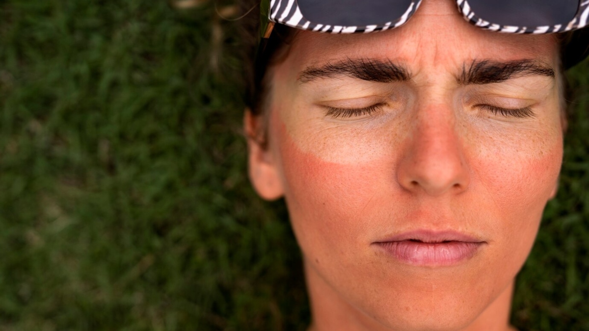 Tanned skin? Try these 5 home remedies to get instant relief from sunburn