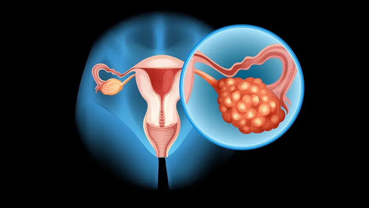 What is Ovarian cancer? Know causes, signs, symptoms, treatment and precautions of the disease