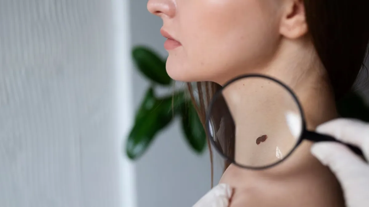 Doctors said that new growth, size and colour of moles may be skin cancer.