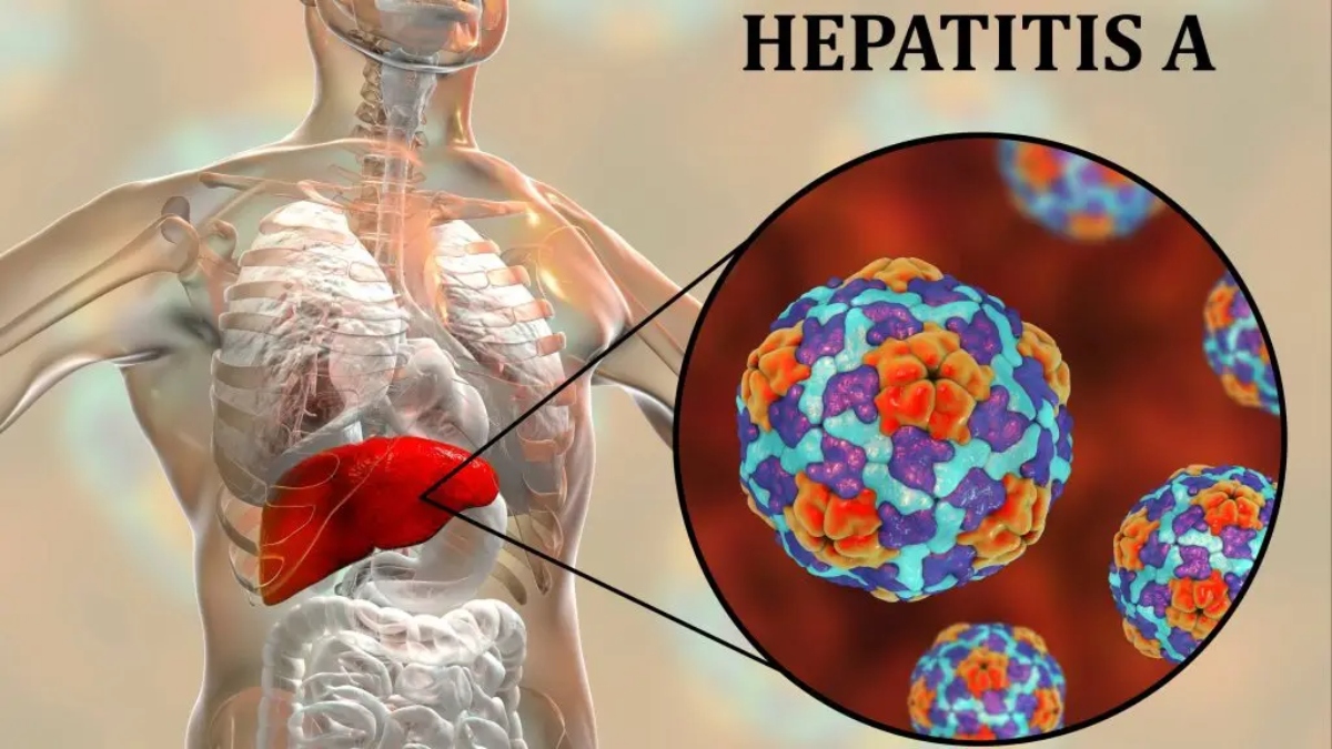 Delhi undergoes massive surge in Hepatitis A cases; know causes, symptoms, treatment and preventive measures – India TV