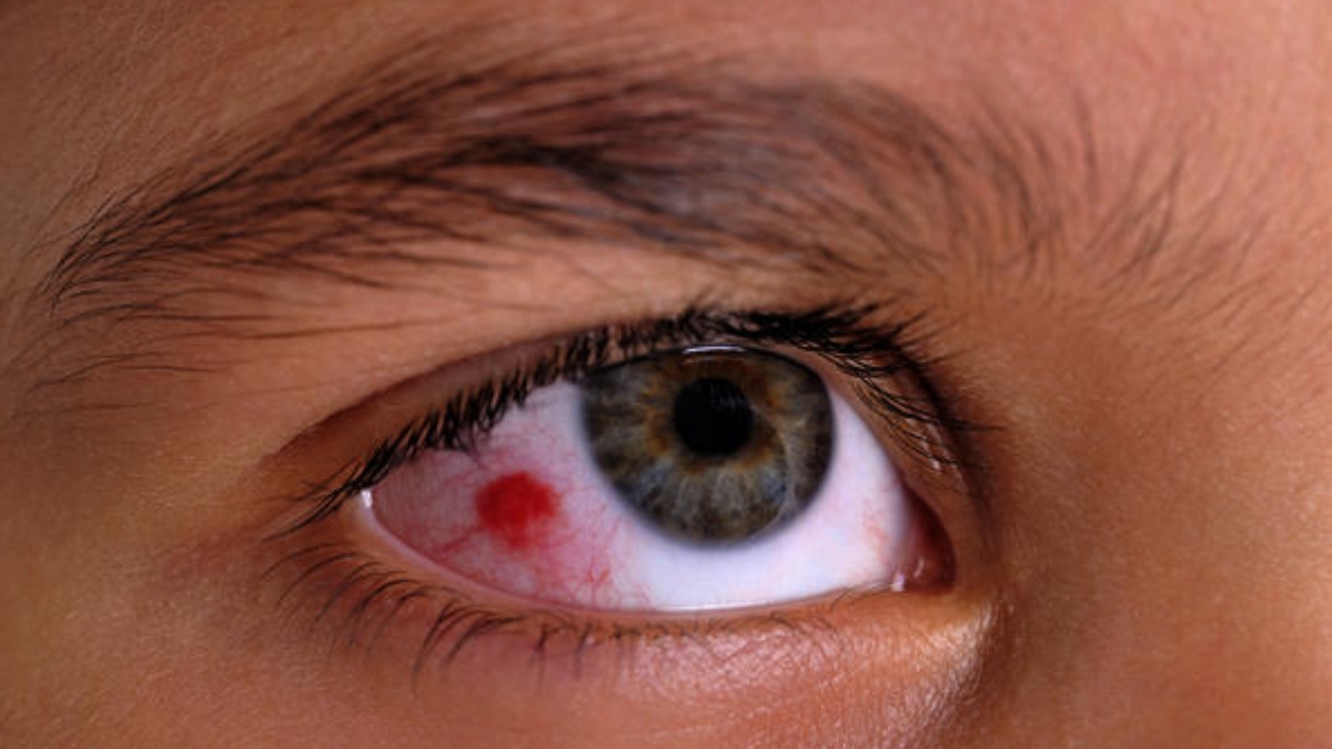 Conjunctivitis and Monsoon Effective tips to prevent pink eyes during
