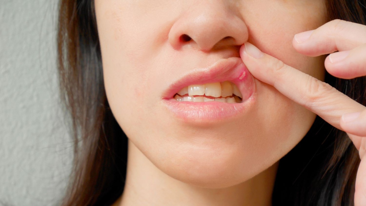 Grappling in pain with Mouth Ulcers? Know causes, symptoms, prevention and ways to cure these sores