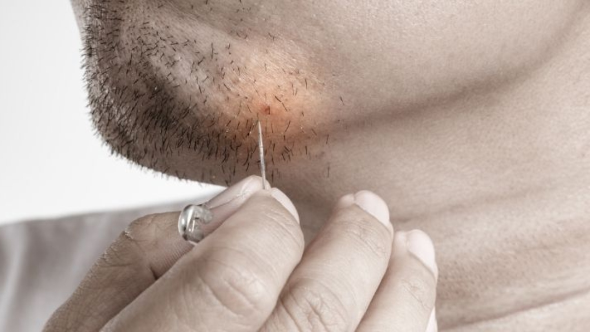 What is Ingrown Hair? Know causes, symptoms, treatment and ways to prevent it