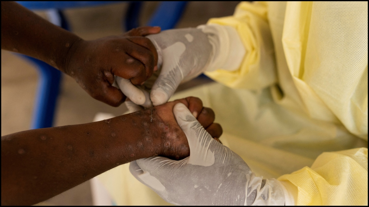 Pakistan reports three cases of new Mpox virus in 2024, China to screen