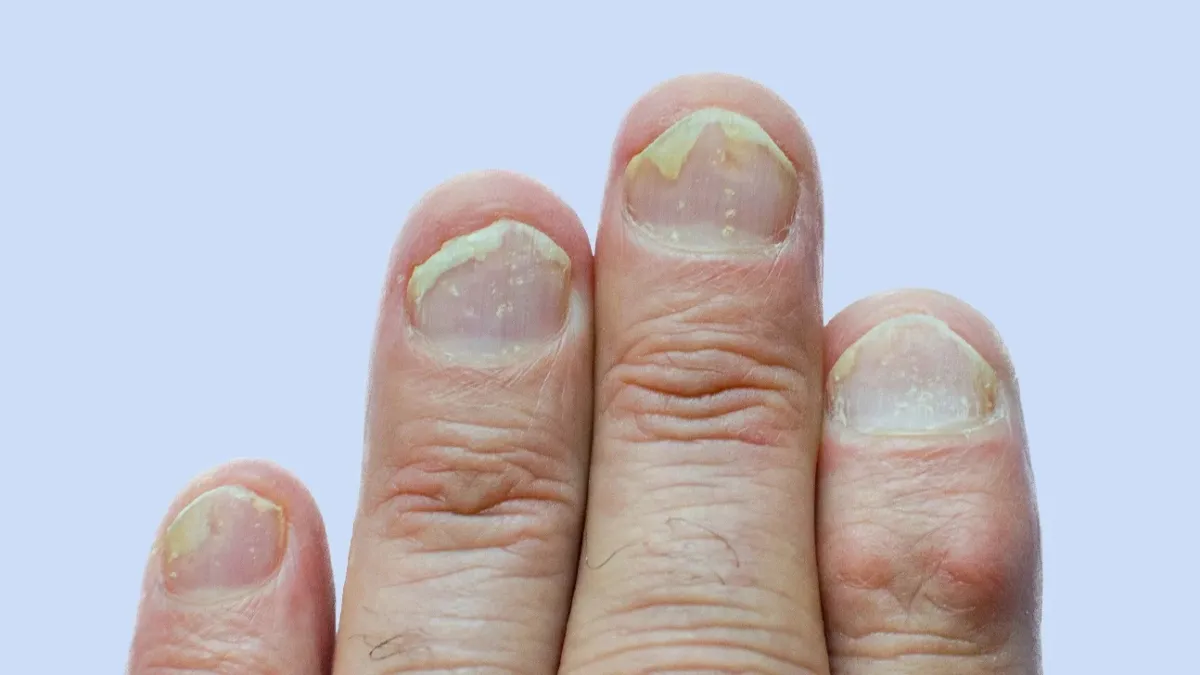5 unusual signs of Nail Psoriasis