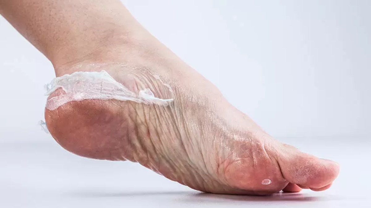 Struggling with Foot Problems? 5 effective ways to cure them