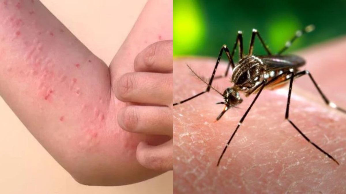 Chikungunya's new variant wreaks havoc in Pune; know causes, symptoms and ways to prevent this viral disease