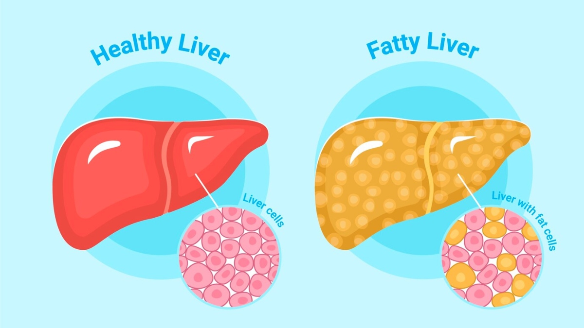 Fatty liver causes several serious health issues, know how to keep the organ healthy