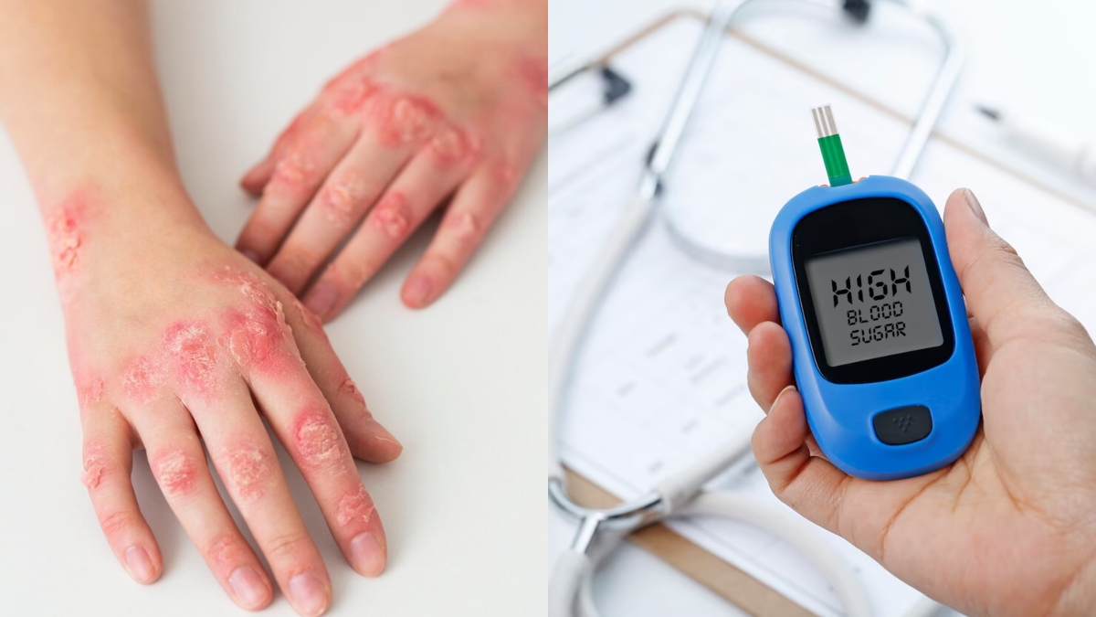 Gangrene spreads rapidly in diabetic patients, know ways to diagnose early and prevention tips