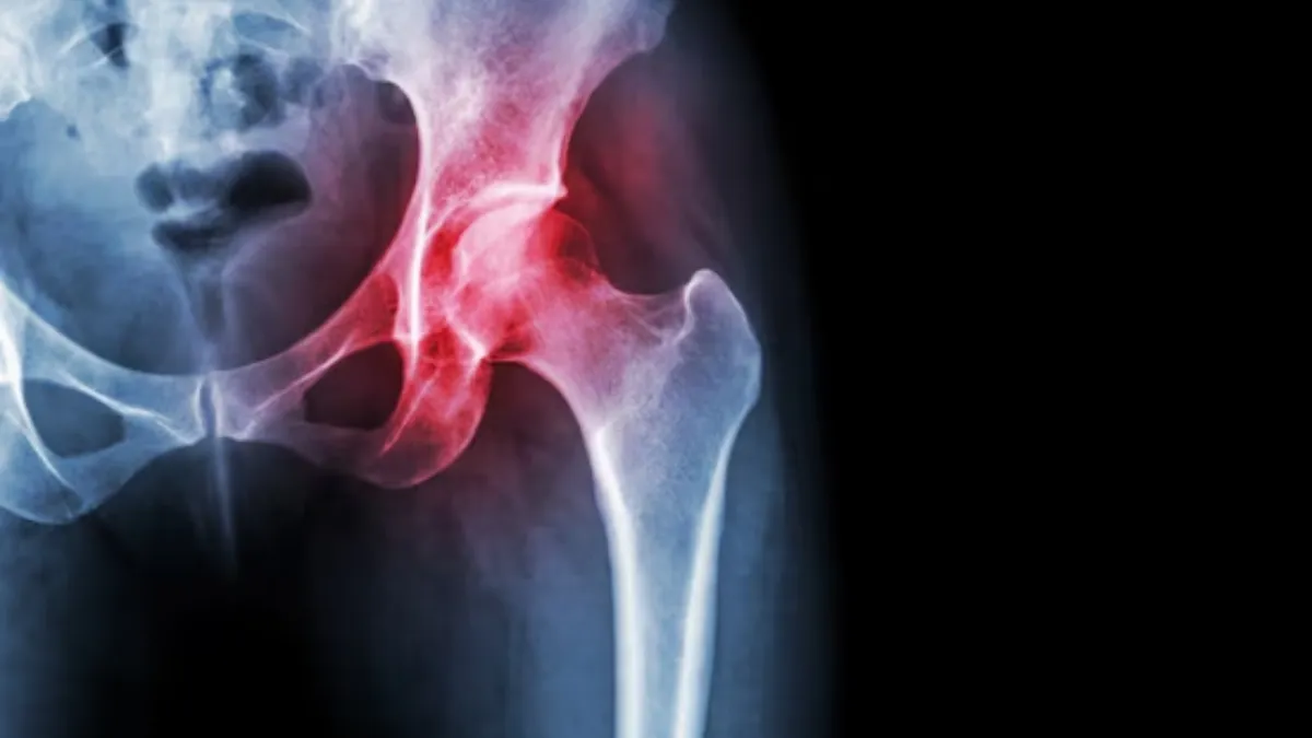 Know the types, causes and treatment of hip arthritis.