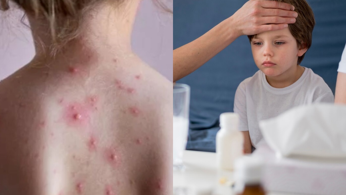 Mpox vs Childhood Common Illnesses: Know the key differences and when ...